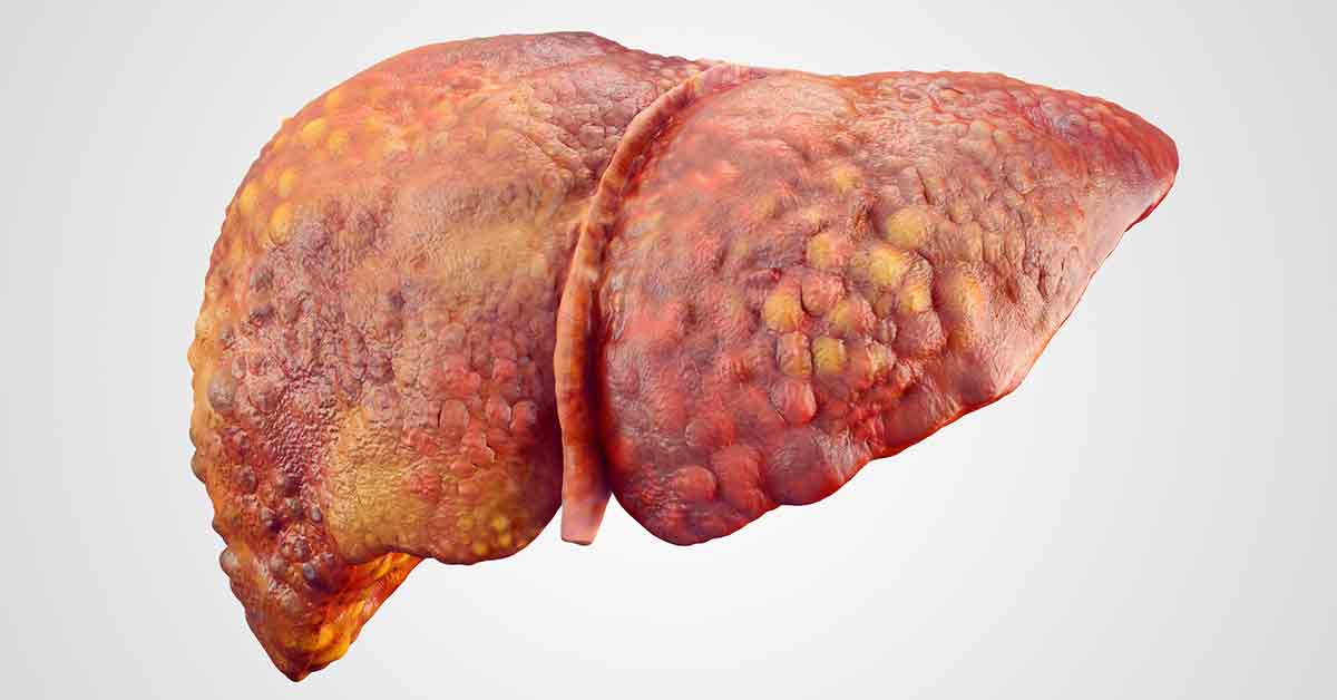 Liver with Cirrhosis