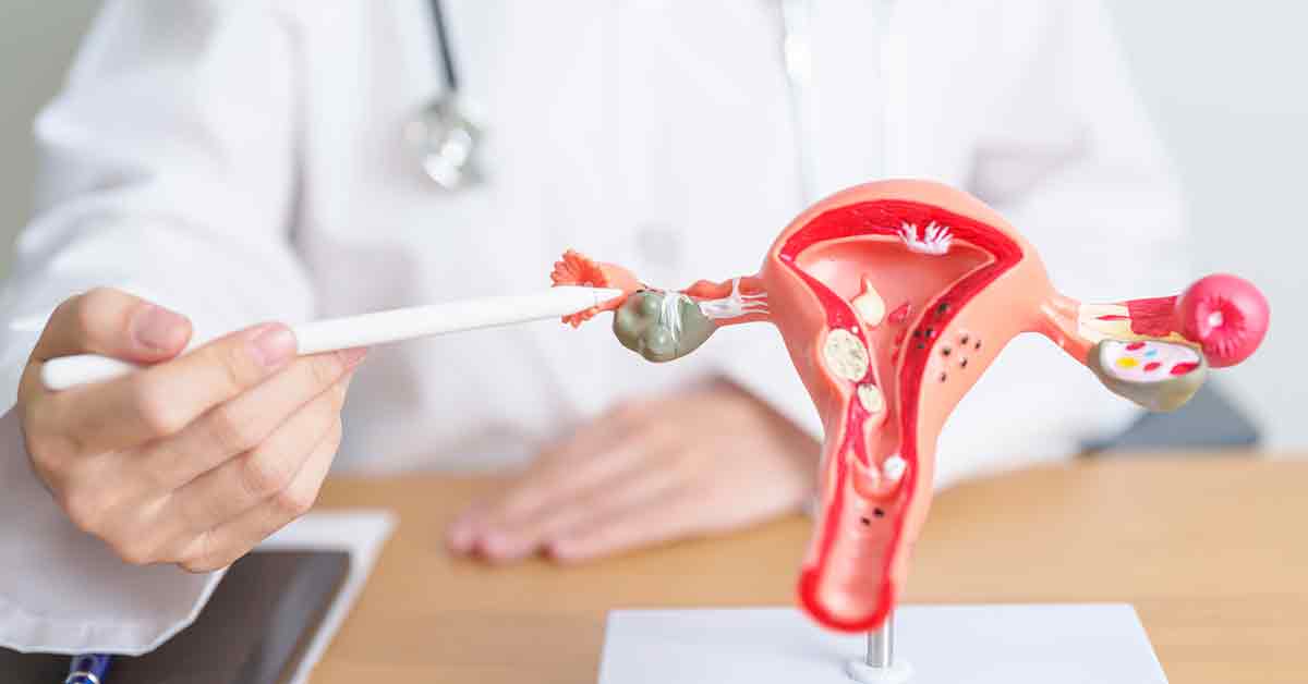 Doctor with Uterus and Ovaries anatomy model. Ovarian and Cervical cancer, Cervix disorder, Endometriosis, Hysterectomy, Uterine fibroids, Reproductive system