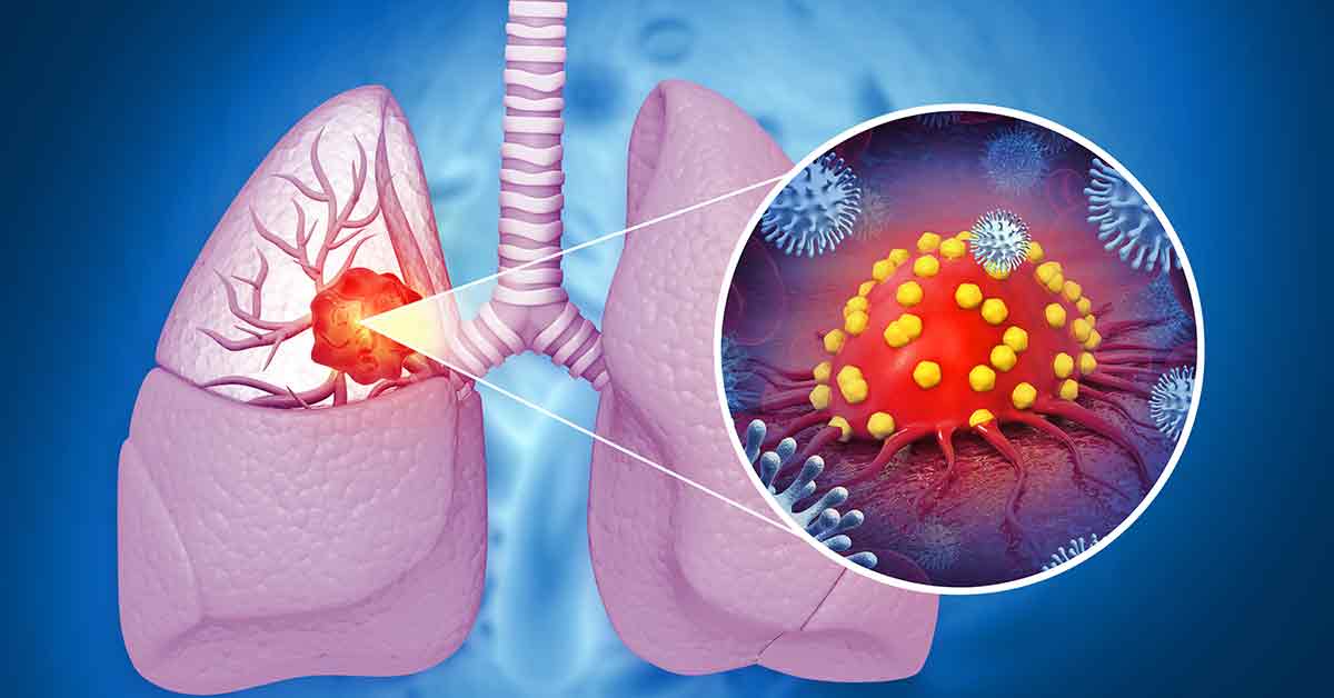 3D rendering of lung cancer