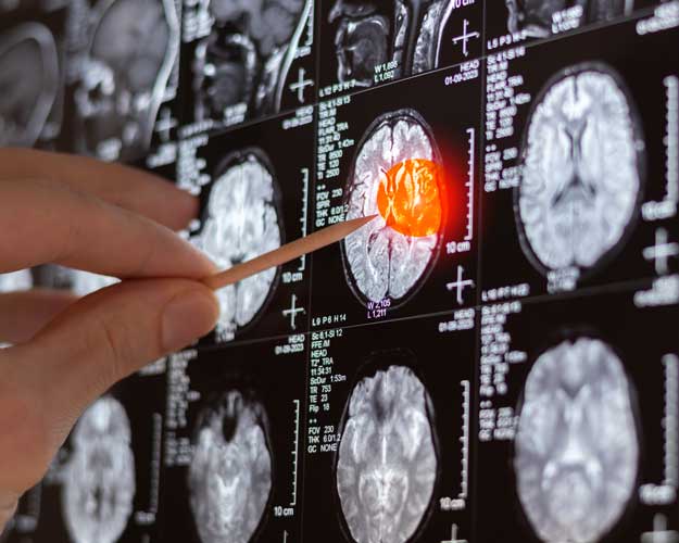 MRI of Brain