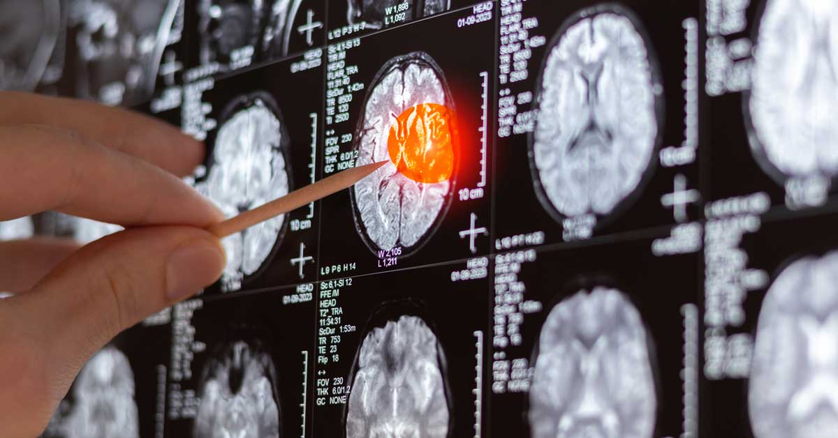 Doctor examining MRI, MRT, CT scanimage of human brain